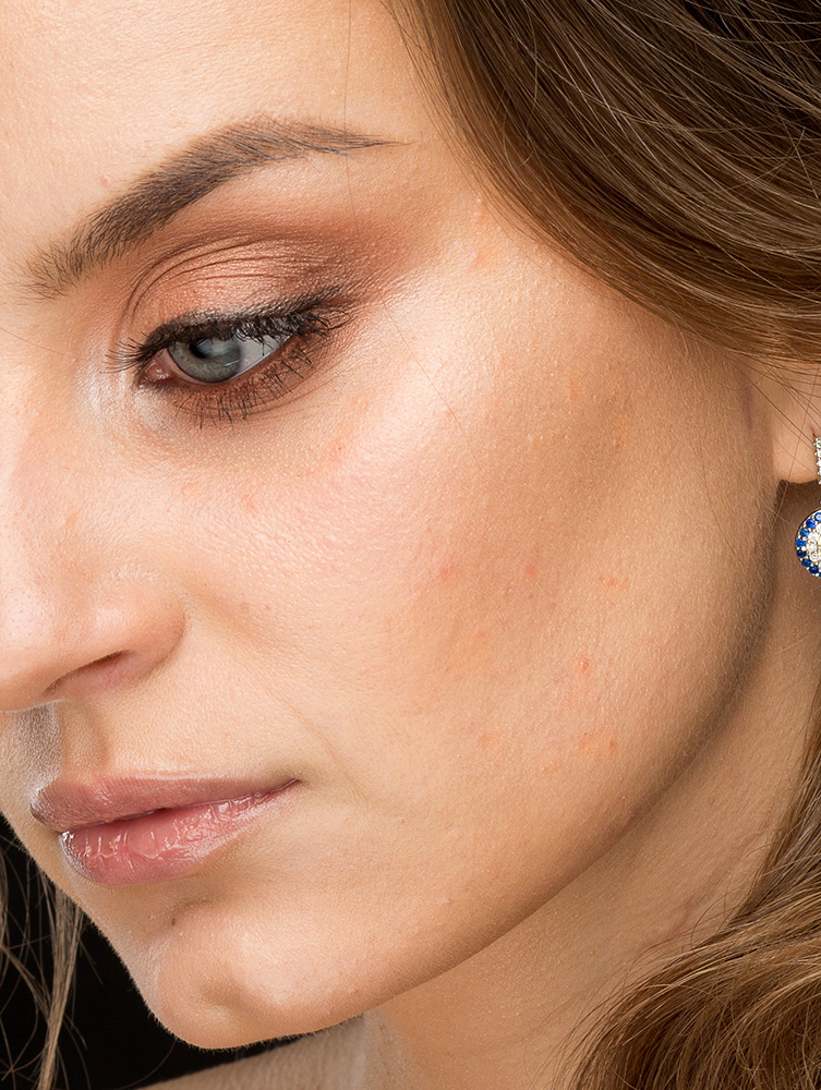 head retouching, acne removal