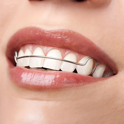 Braces removal before