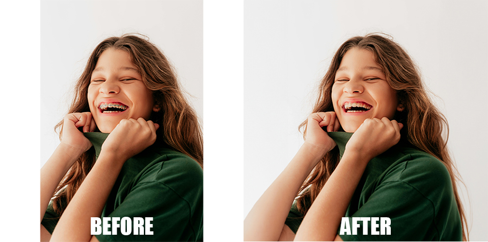 Braces removal