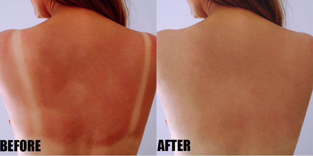 tan line removal
