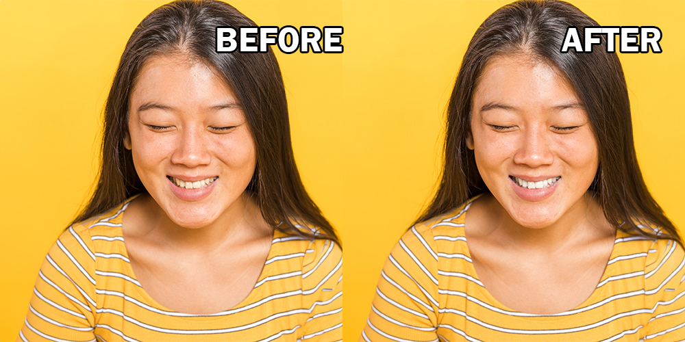 teeth whitening