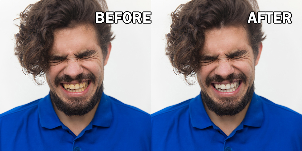 teeth whitening