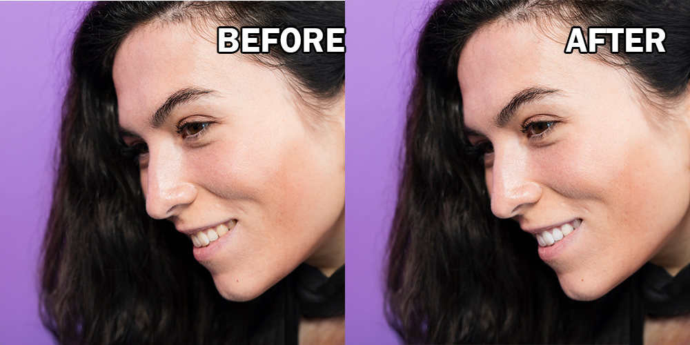 teeth whitening